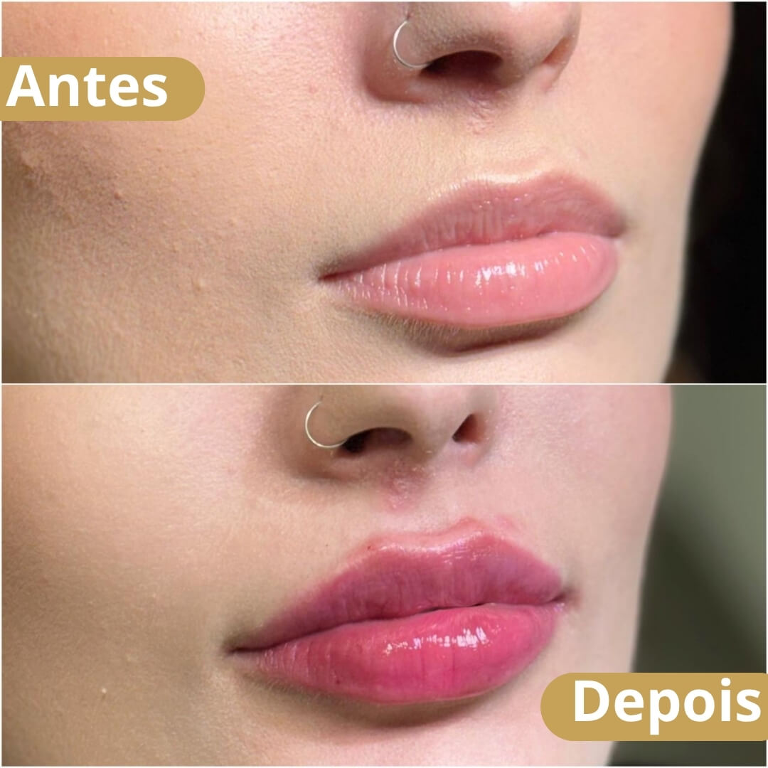 preenchimento labial