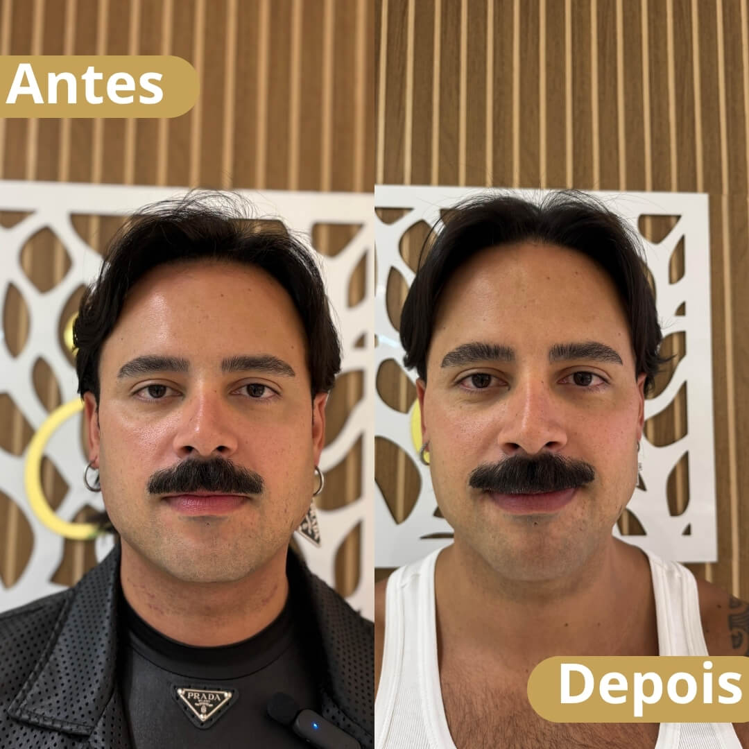 Harmonização Facial