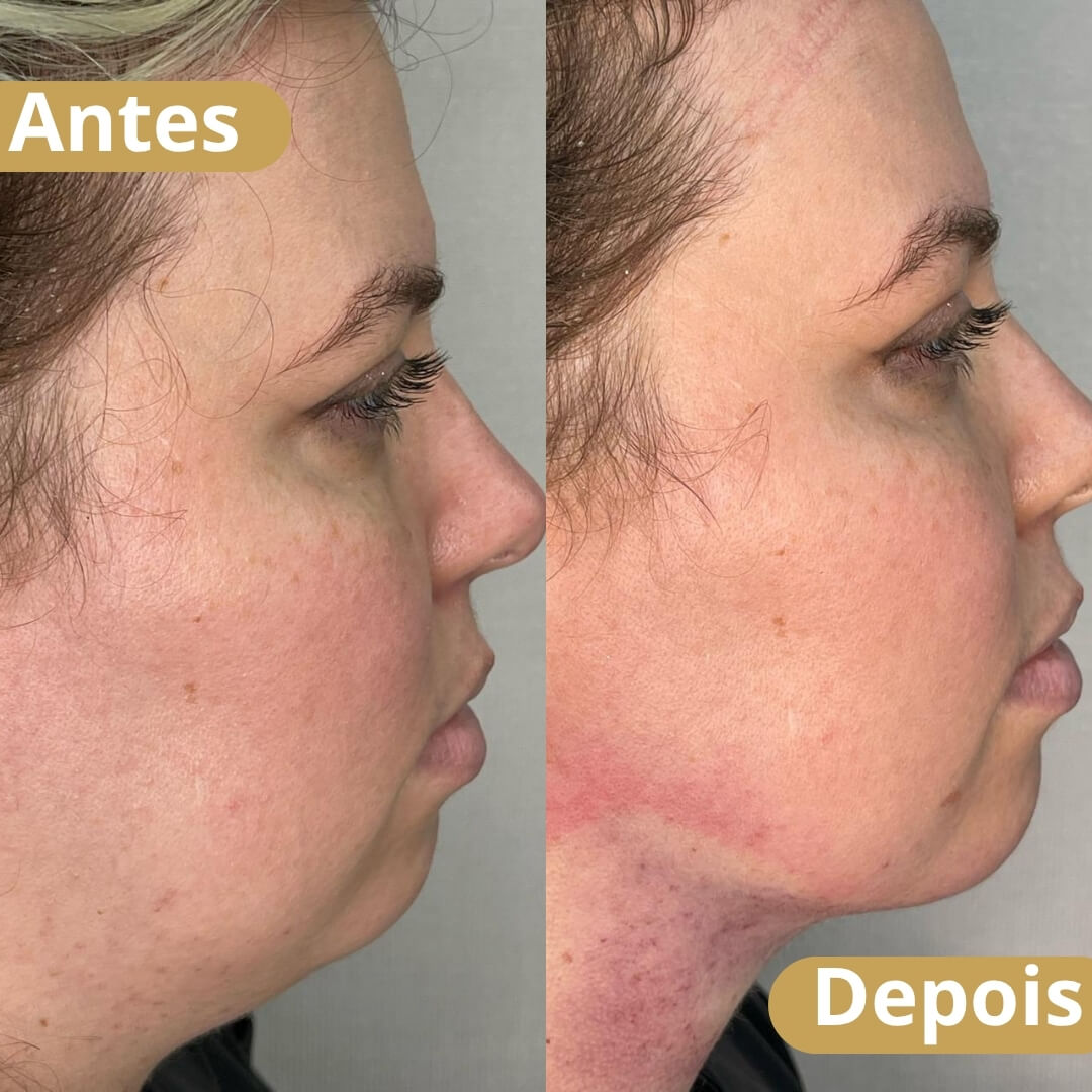 Lipo HD de Papada​ - 3