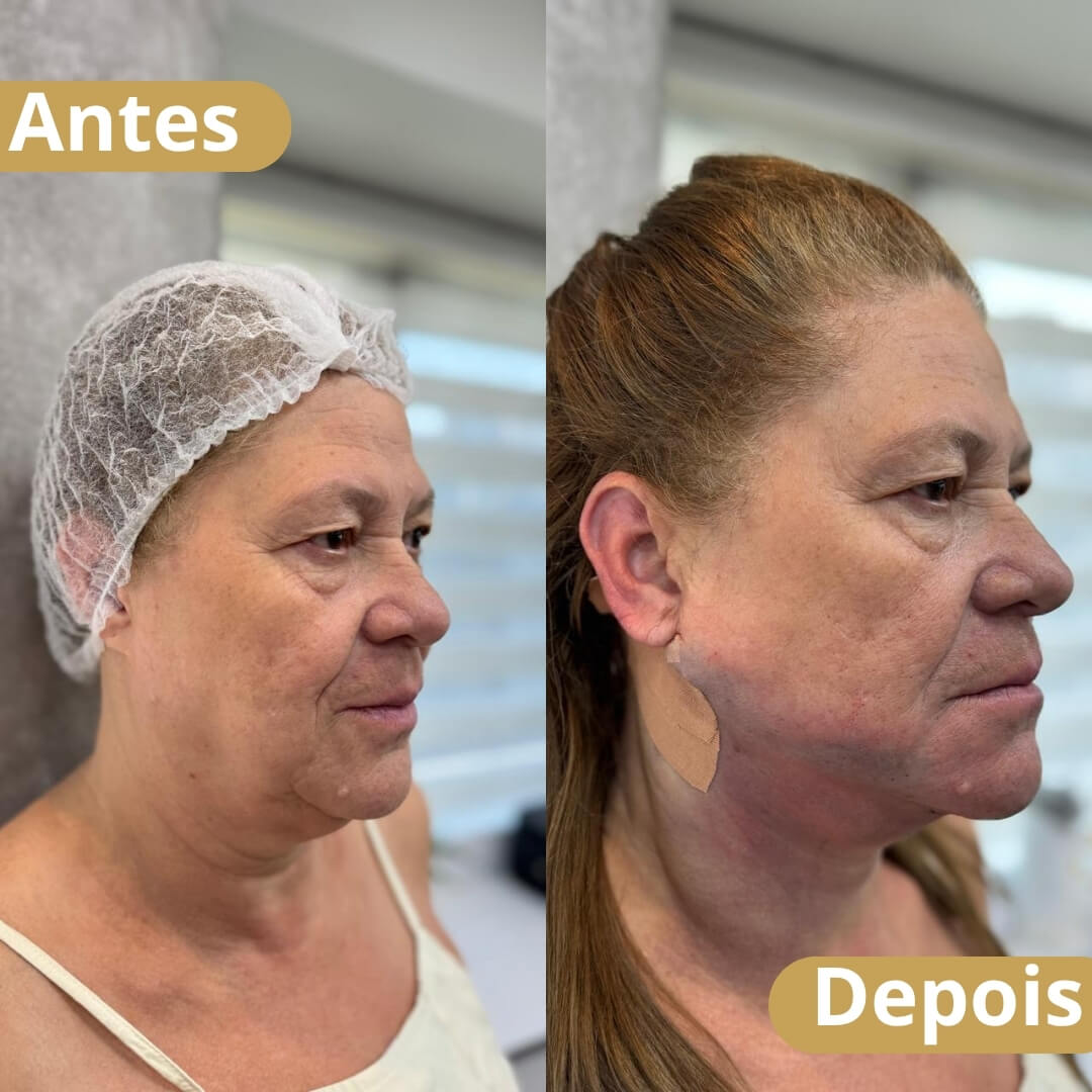 Lipoaspiração Hd Modificada