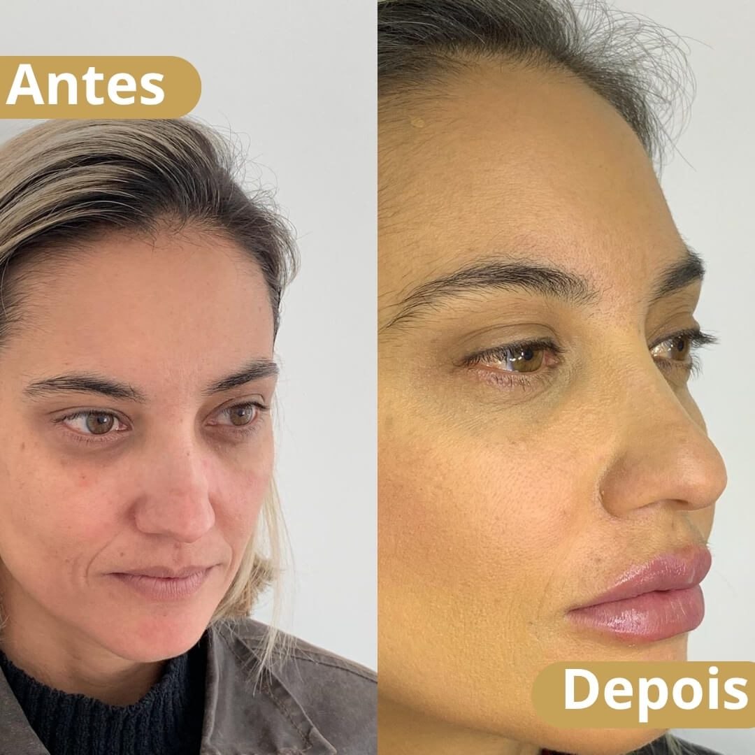 preenchimento labial e bigode chinês - dra joilma faria