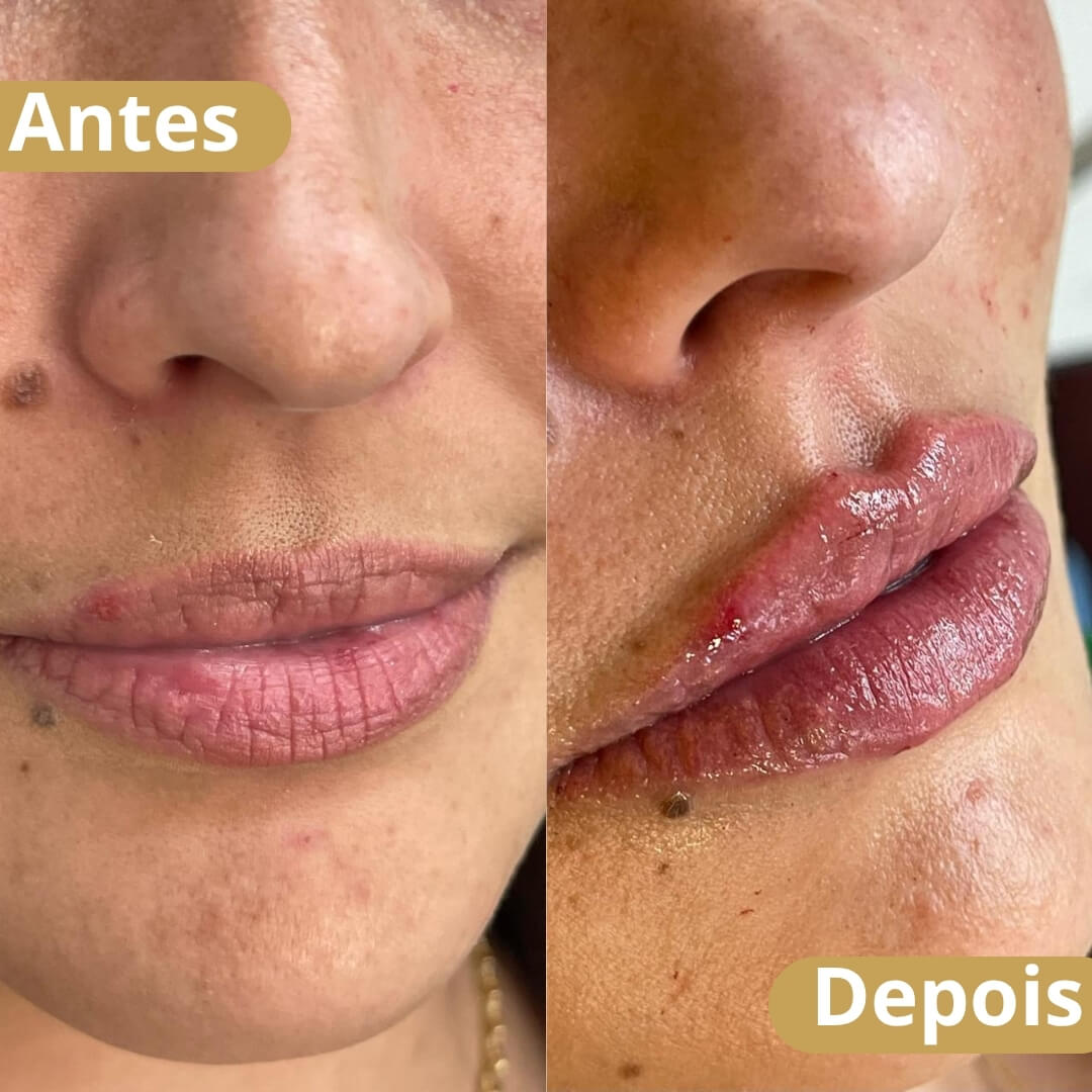 Preenchimento Labial