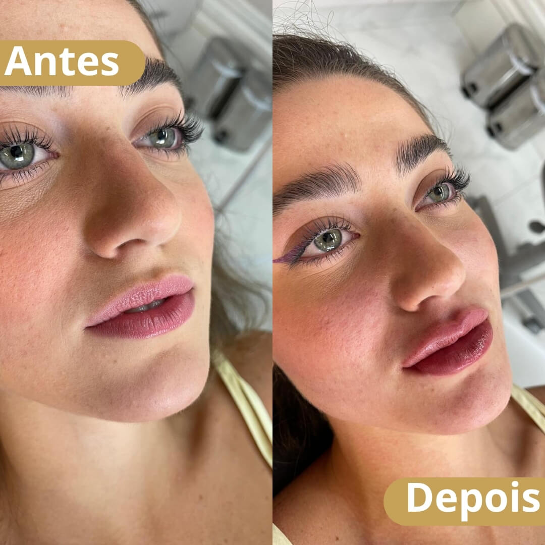 preenchimento labial - dra joilma faria