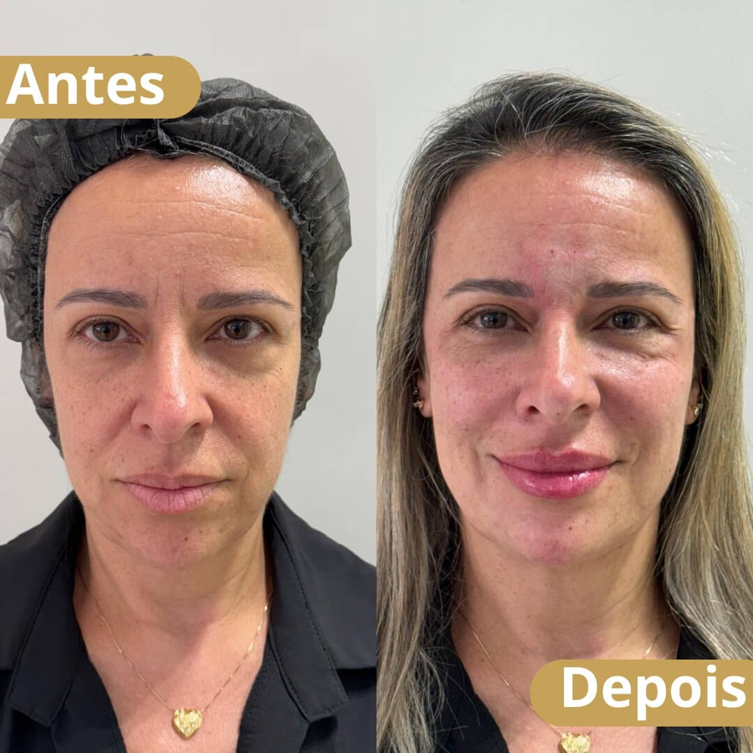 Harmonização facial - 2