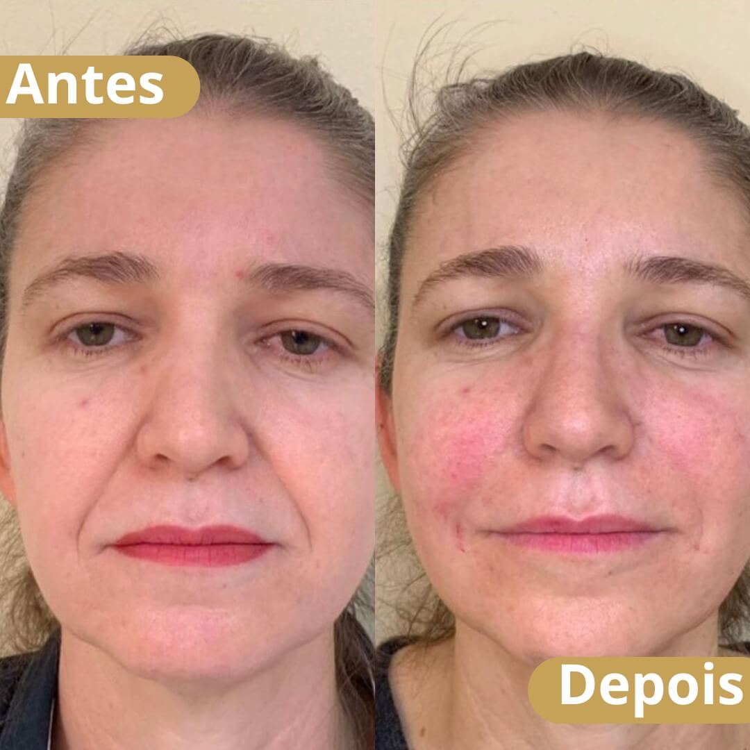 acido hialuronico e bigode chines - novo