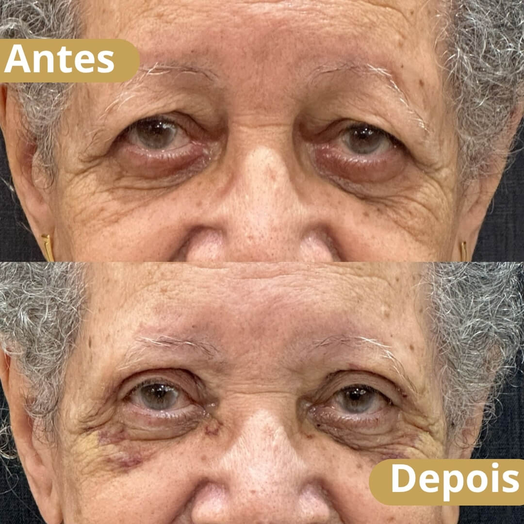blefaroplastia superior-2