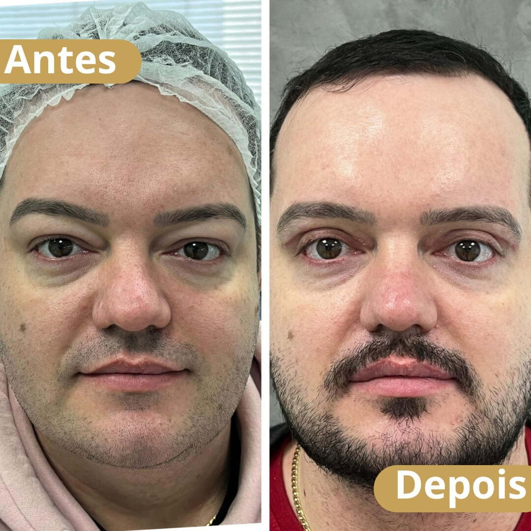blefaroplastia superior