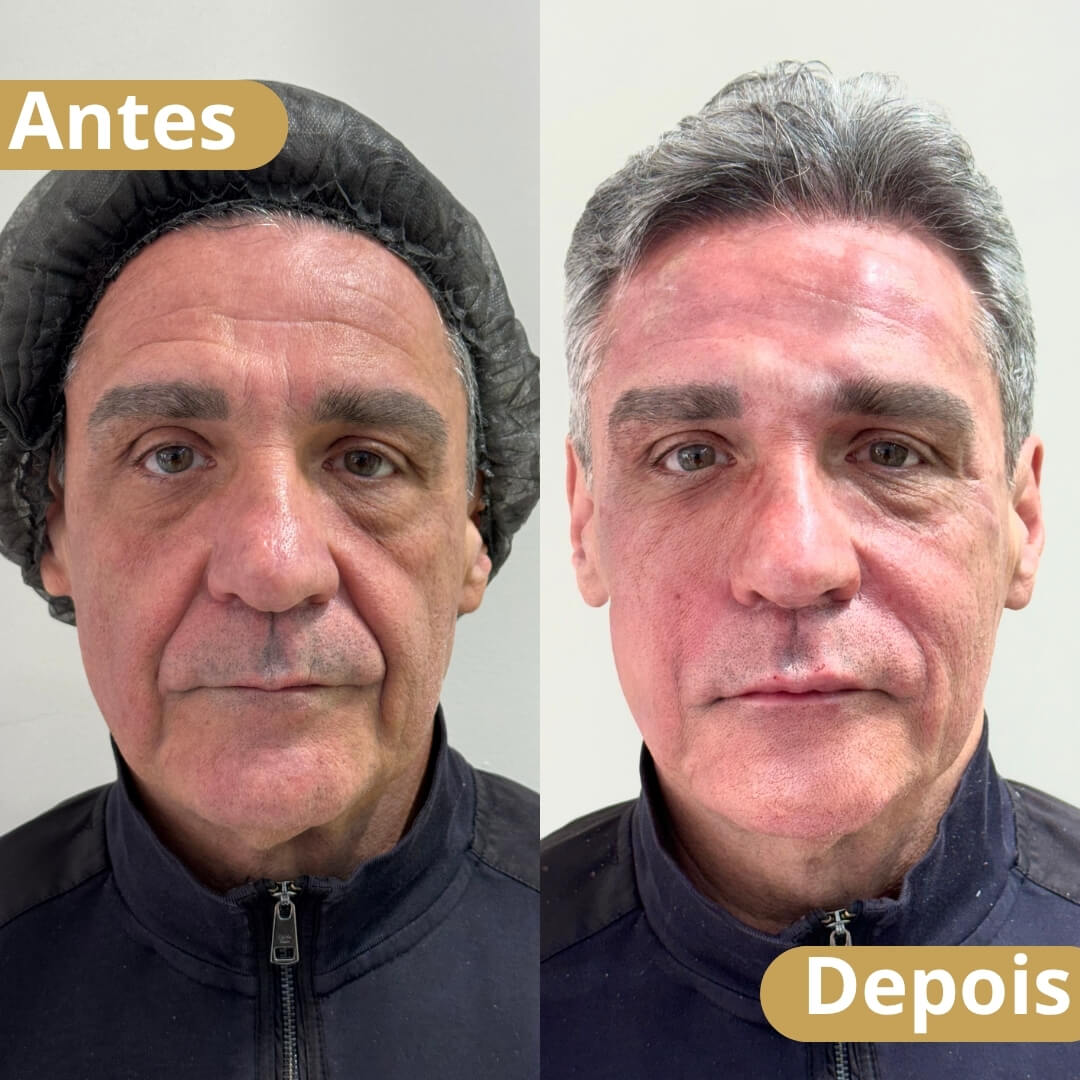 harmonização facial -2