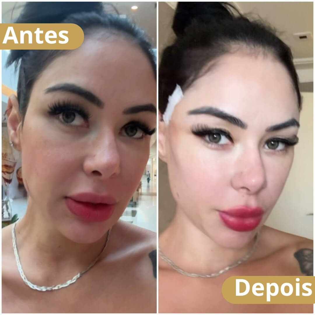 soft lifting - dra joilma faria